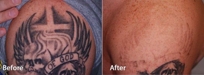 Pico Way Tattoo Removal Before and After Photo