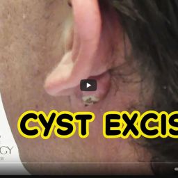 Dermatologist Dr. Timothy Jochen demonstrates a cyst excision on a patient that has reoccurring cysts.