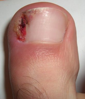Ingrown toe nail