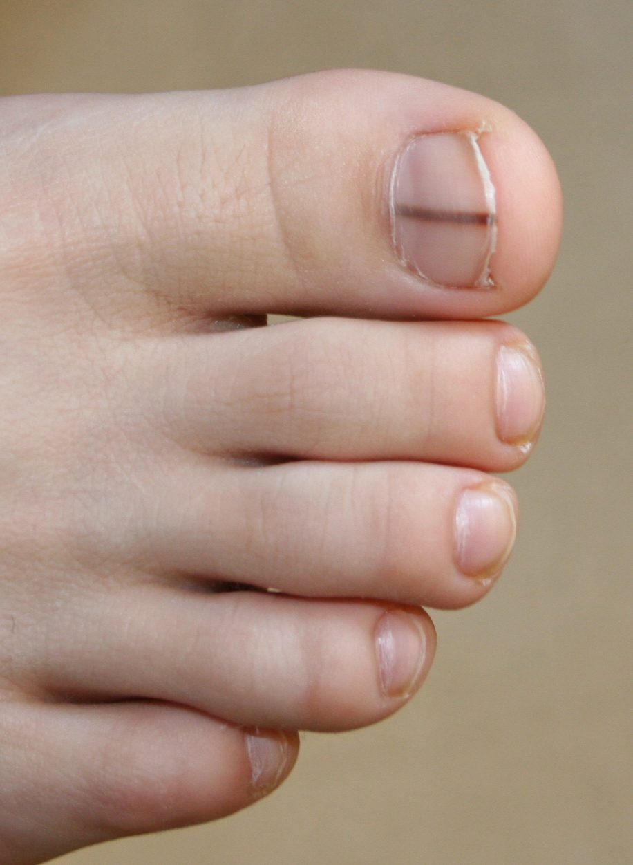 Nail Dystrophy and Disease | Contour Dermatology
