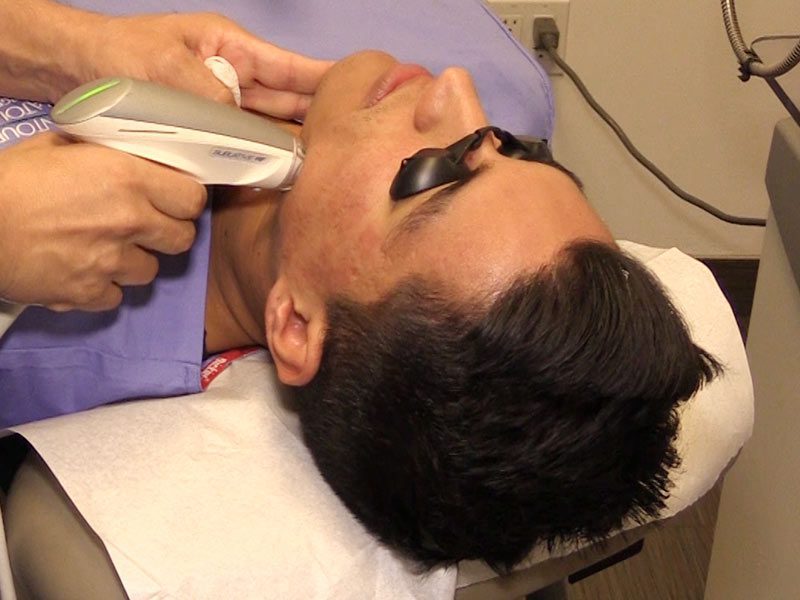 Sublative acne scar treatment