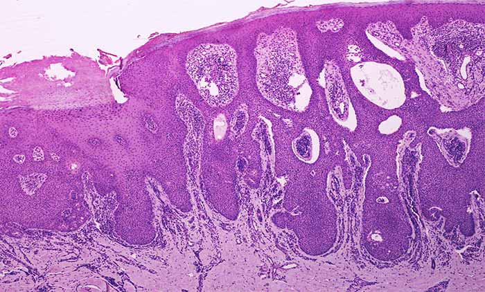 Skin Tumors | Contour Dermatology