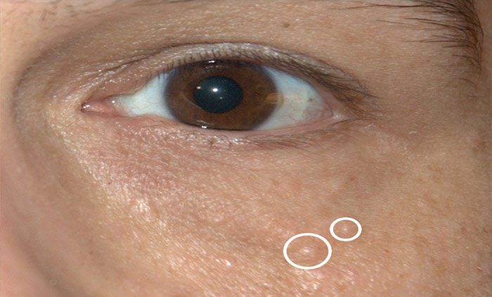 Syringoma | Skin Condition | Contour Dermatology