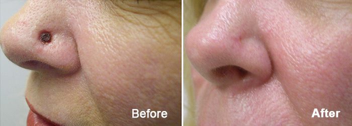 Before and after photo of an actual Contour Dermatology Mohs Surgery patient | Contour Dermatology Before and after photo of an actual Contour Dermatology Mohs Surgery patient