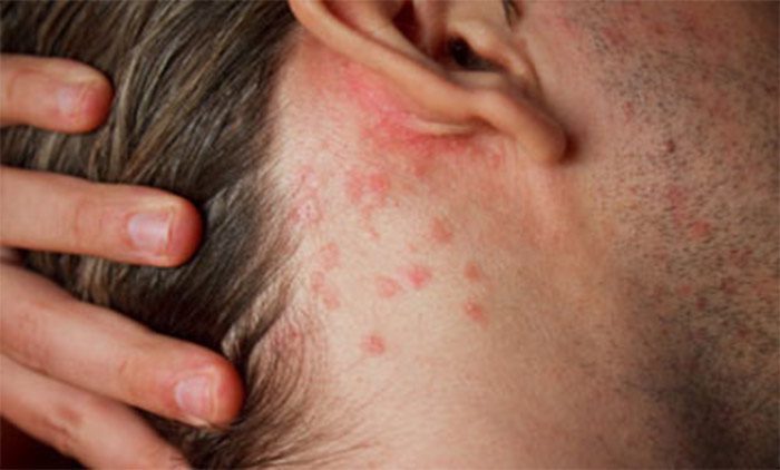 There are many different topical steroids – in the United States they are classified into seven groups based on their vasoconstrictive properties with group one being the strongest and group seven being the weakest.