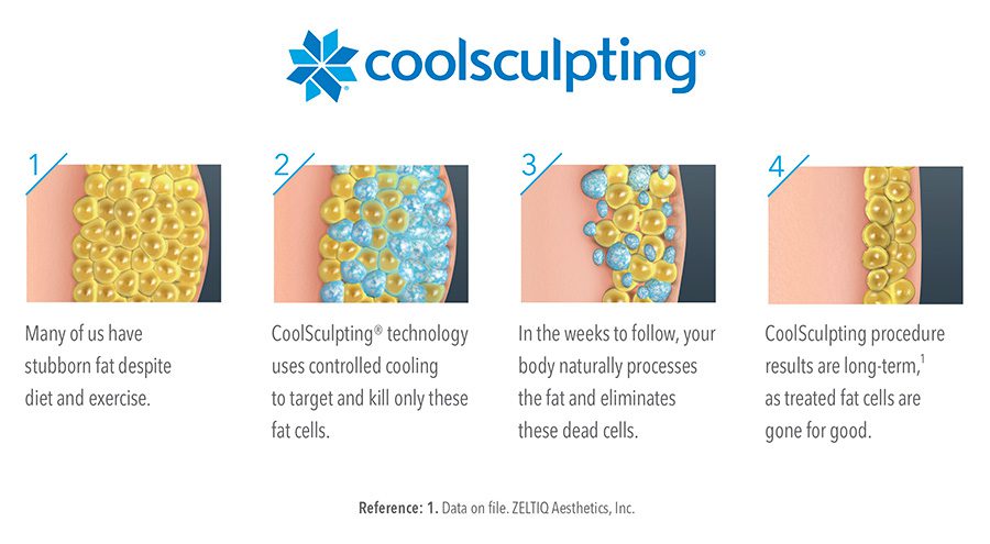 How CoolSculpting works, step by step.