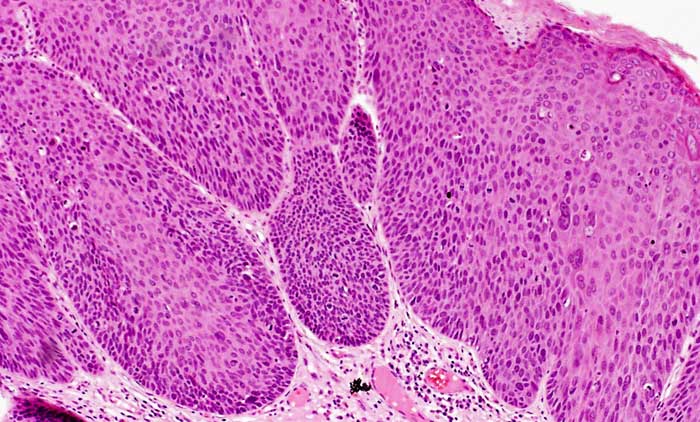 Bowenoid Papulosis | Contour Dermatology Bowenoid Papulosis