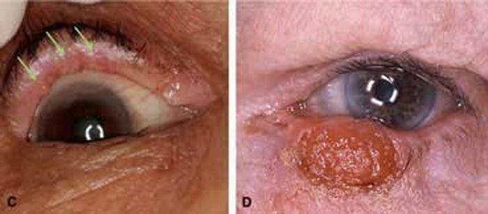 Sebaceous Carcinoma | Contour Dermatology Sebaceous Carcinoma