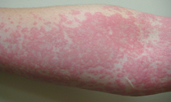 Urticaria