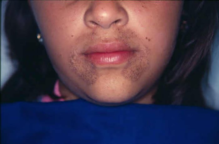 Alkaptonuria | Contour Dermatology Alkaptonuria