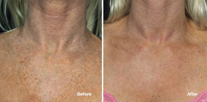 Fraxel for Décolletage before and after photo