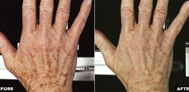 Fraxel Laser Before and After for Hands