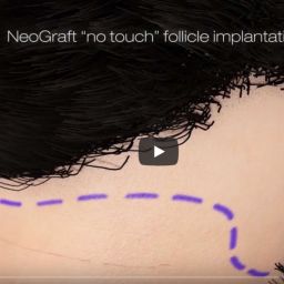 NeoGraft® introduces the “state-of-the-art” solution for hair loss. This game changing technology automates the Follicular Unit Extraction (FUE) method to give patients more natural looking results with minimal downtime, no linear scaring and no stitches.