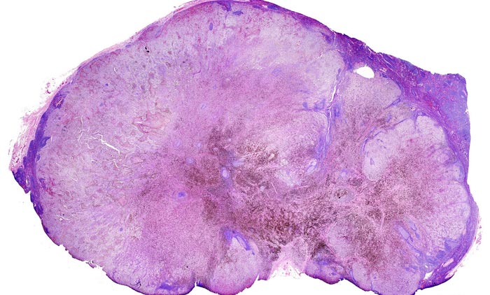 Melanoma-Biopsy | Contour Dermatology