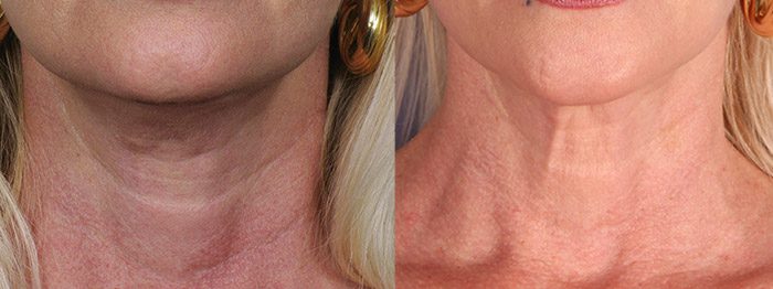 Neck filler before and after | Contour Dermatology Neck filler before and after