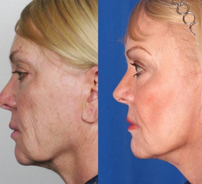 mini-facelift-before-after-1-5-lg