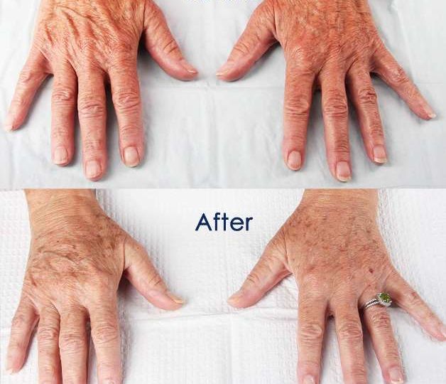Hand rejuvenation