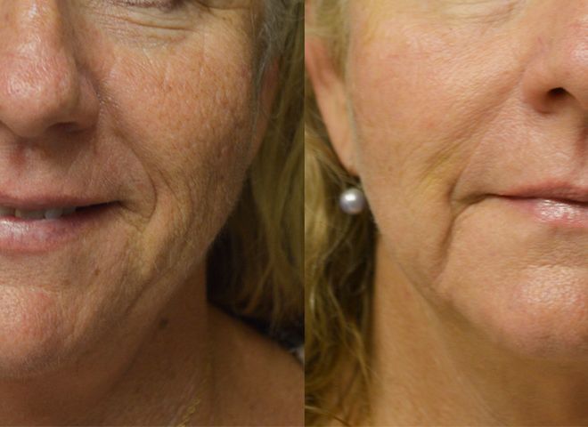 PicoWay Resolve Laser Before and After