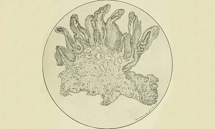 Low power magnified section of Condylomata Acuminata Vulvae - Genital Warts