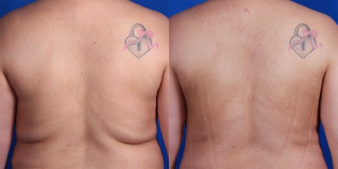 Lipo in the back area before and after