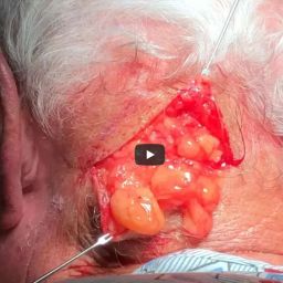 Doctor removes a stubborn 15 year old lipoma from a man’s neck at Contour Dermatology and Cosmetic Surgery Center. This fatty, benign growth has attached to the skin, and formed in clusters,