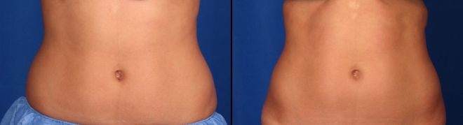 CoolSculpting results after 2 treatments on the lower abdomen