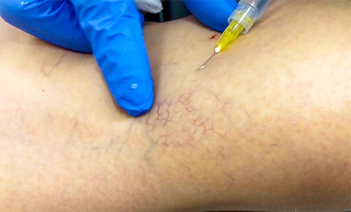 Sclerotherapy treatment for spider veins