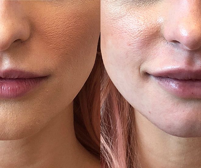 Restylane Lyft results for the lips