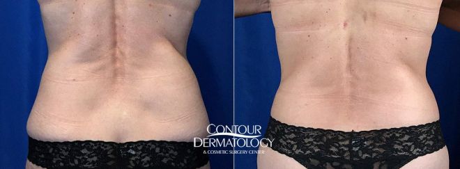 Actual Contour Dermatology Patient CoolSculpting Before and After – Flanks