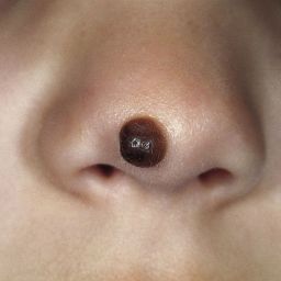 Congenital Nevus | Contour Dermatology Congenital Nevus