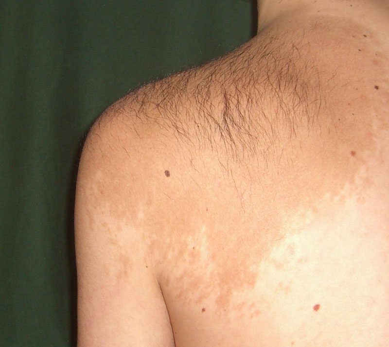 Becker's Nevus | Contour Dermatology Becker's Nevus