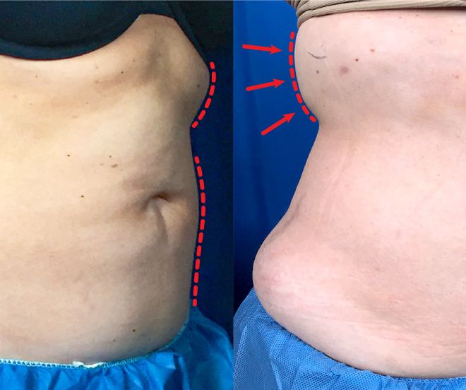 One day post treatment liposuction results of the abdomen and bra fat