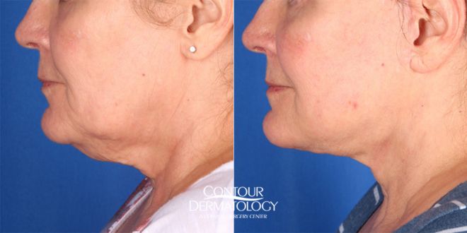 Chin Liposuction with Mini Facelift combination treatment