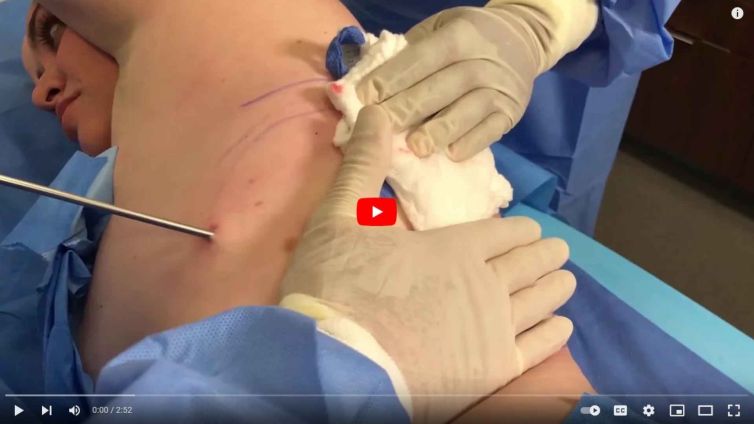 Liposuction and Fat Transfer Demonstration at Contour Dermatology
