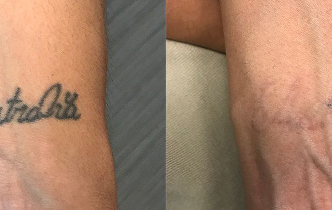 Laser Tattoo Removal on Wrist