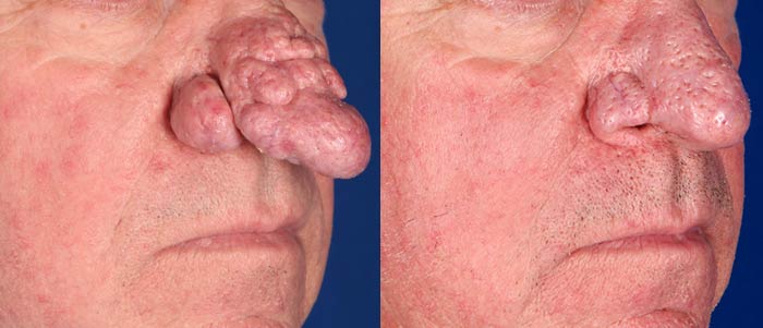 Rhinophyma after 3 Fractional CO2 Laser treatments | Contour Dermatology Rhinophyma after 3 Fractional CO2 Laser treatments