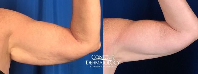 CoolSculpting for Arms before and after, 8 months after one treatment.