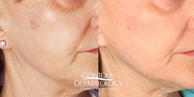 Fraxel Laser for Face - Contour Dermatology Patient