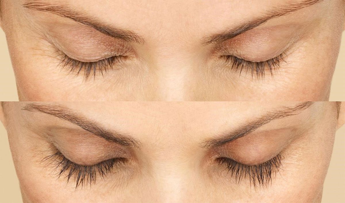 20190314-Latisse-before-after-1-lg | Contour Dermatology Before Latisse® and at week 16