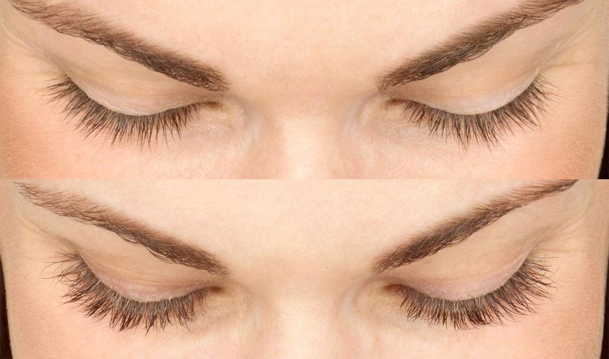 20190314-Latisse-before-after-3-lg | Contour Dermatology Before Latisse® and at week 16
