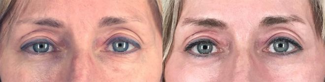 Lower Eyelid Surgery (Lower Bleph) plus CO2 Laser Resurfacing around Eyes, 1 month after