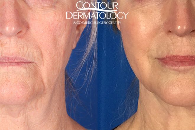 Mini Facelift with CO2, 8 Months Post Treatment
