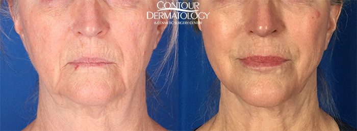 Mini Facelift with CO2, 8 Months Post Treatment
