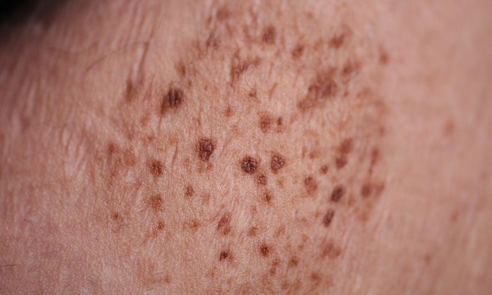 Another name for Nevus Spilus (nevi plural) is Speckled Lentiginous Nevus. The spots can be flat or raised. | Contour Dermatology Another name for Nevus Spilus (nevi plural) is Speckled Lentiginous Nevus. The spots can be flat or raised.