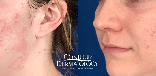 Smoothbeam Laser Treatment for acne scarring