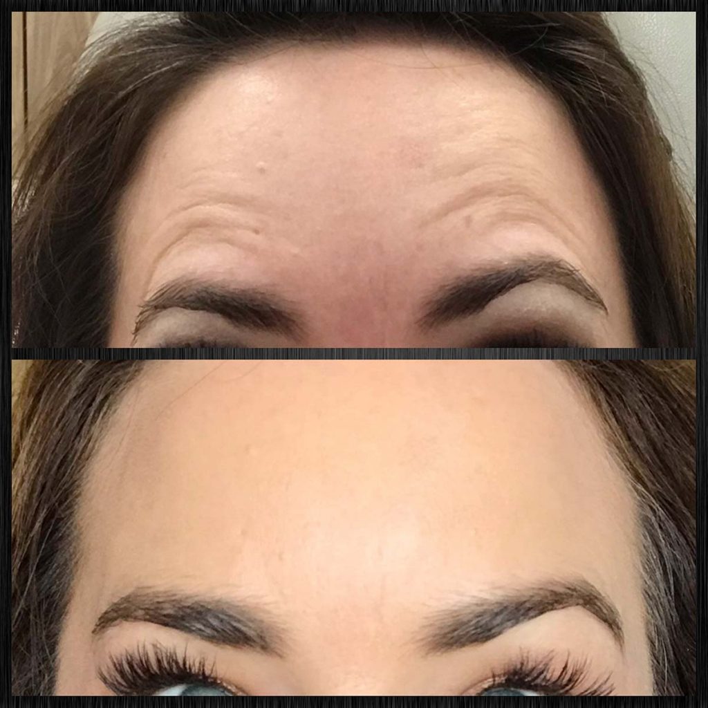 Botox treatment for worry lines above eyebrows