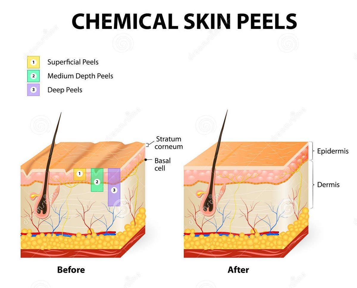 Chemical-peels-1-lg | Contour Dermatology Skin Chart