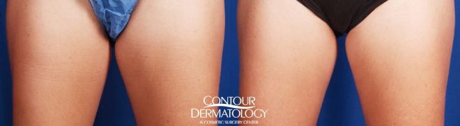CoolSculpting, Inner Thighs, 2 Treatments, 5 Months After