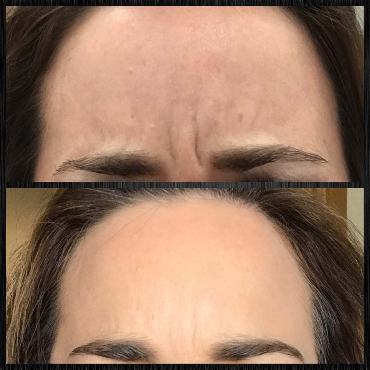 Botox treatment for frown lines (11s) between eyebrows.