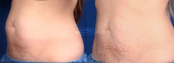 2 Treatments of CoolSculpting and VelaShape on Abdomen